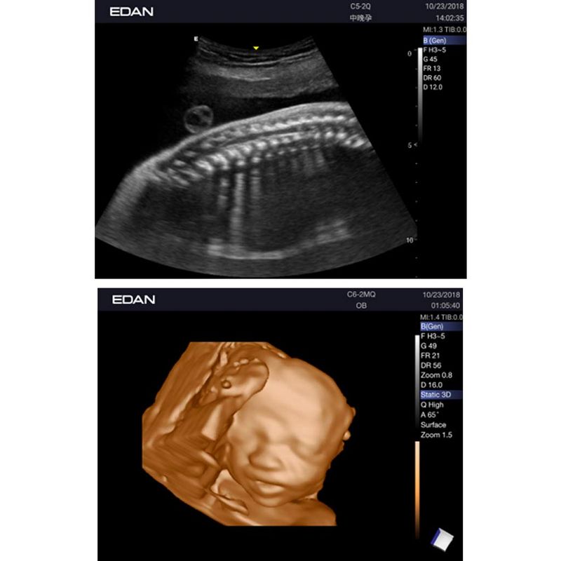 ultrassom-ax3-edan-dormed-15